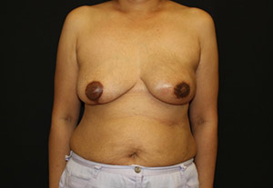 After Breast Reconstruction