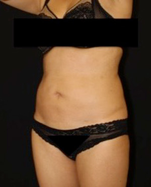 Liposuction Results Tacoma