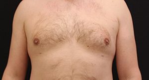 Male Breast Reduction Result Tacoma