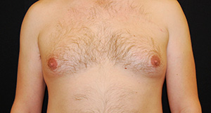 Male Breast Reduction Result Tacoma