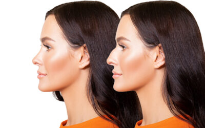 Rhinoplasty Surgery and Cartilage Grafts