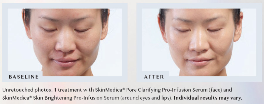 Skin Brightening Treatment Results Tacoma