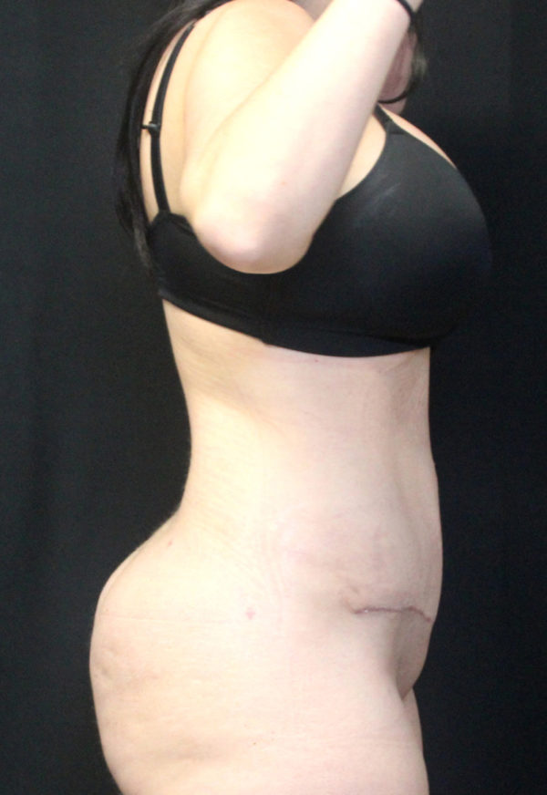 Liposuction