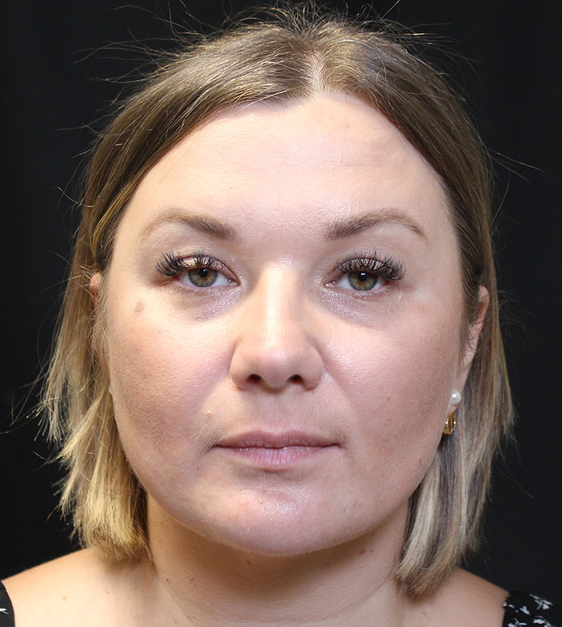 Forehead Lift Surgery Results Tacoma