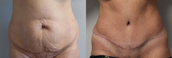 Abdominoplasty (Tummy Tuck) before and after photos by Dr. Philip C. Kierney in Puyallup, WA