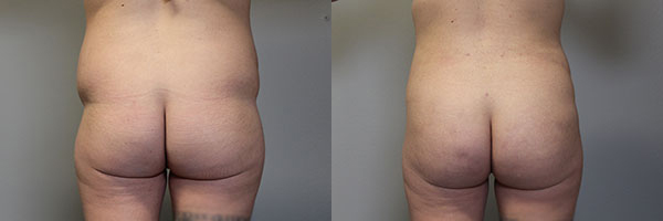 Brazilian Butt Lift before and after photos by Dr. Philip C. Kierney in Puyallup, WA