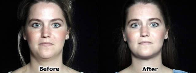 Cheek, Chin Implants before and after photos by Dr. Philip C. Kierney in Puyallup, WA