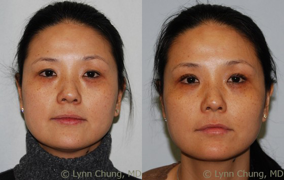 Facial Fat Grafting before and after photos by Dr. Philip C. Kierney in Puyallup, WA