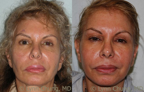 Full Facelift before and after photos by Dr. Philip C. Kierney in Puyallup, WA