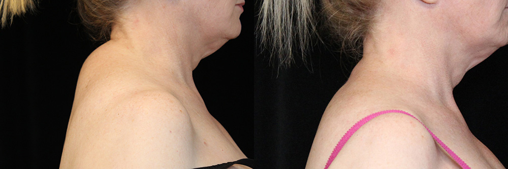 Liposuction before and after photos by Dr. Philip C. Kierney in Puyallup, WA