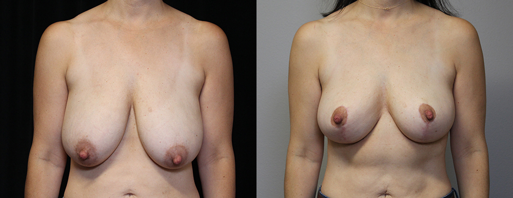 Mastopexy (Breast Lift) before and after photos by Dr. Philip C. Kierney in Puyallup, WA