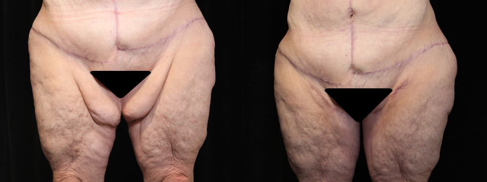 Thigh Lift before and after photos by Dr. Philip C. Kierney in Puyallup, WA
