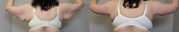 Arm Lift before and after photos by Dr. Philip C. Kierney in Puyallup, WA