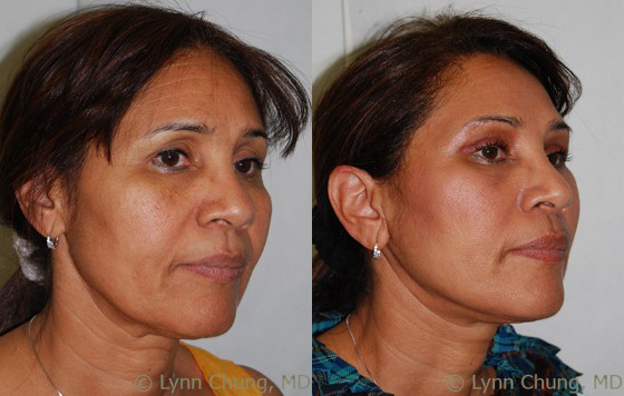 Neck Lift before and after photos by Dr. Philip C. Kierney in Puyallup, WA