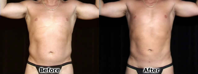 Liposuction before and after photos by Dr. Philip C. Kierney in Puyallup, WA