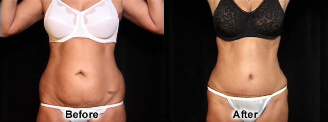 Abdominoplasty (Tummy Tuck) before and after photos by Dr. Philip C. Kierney in Puyallup, WA