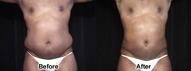 Liposuction before and after photos by Dr. Philip C. Kierney in Puyallup, WA