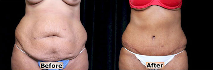Abdominoplasty (Tummy Tuck) before and after photos by Dr. Philip C. Kierney in Puyallup, WA