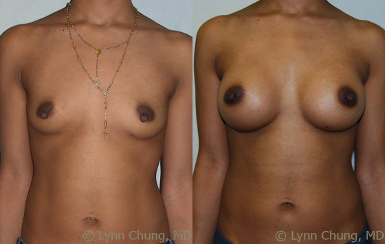 Breast Augmentation before and after photos by Dr. Philip C. Kierney in Puyallup, WA