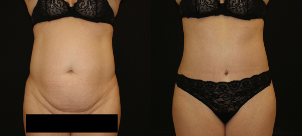 Abdominoplasty (Tummy Tuck) before and after photos by Dr. Philip C. Kierney in Puyallup, WA