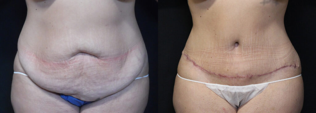 Abdominoplasty (Tummy Tuck) before and after photos by Dr. Philip C. Kierney in Puyallup, WA