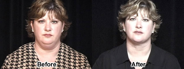 Cheek, Chin Implants before and after photos by Dr. Philip C. Kierney in Puyallup, WA