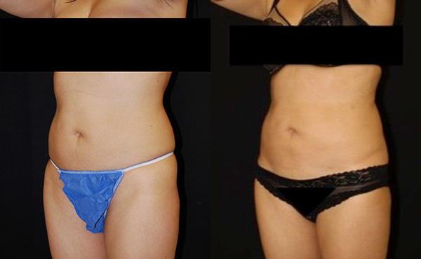 Liposuction before and after photos by Dr. Philip C. Kierney in Puyallup, WA