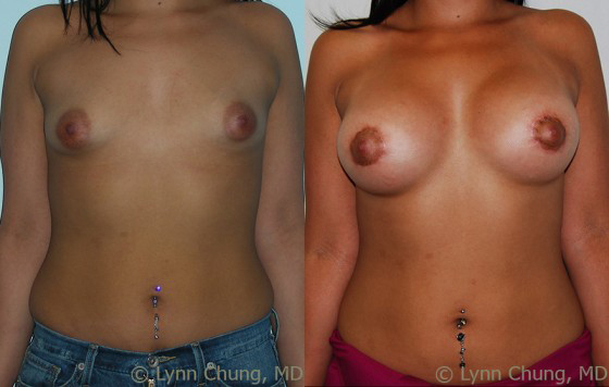 Breast Augmentation before and after photos by Dr. Philip C. Kierney in Puyallup, WA