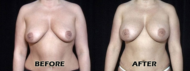 Breast Augmentation before and after photos by Dr. Philip C. Kierney in Puyallup, WA