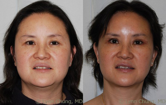 Full Facelift before and after photos by Dr. Philip C. Kierney in Puyallup, WA