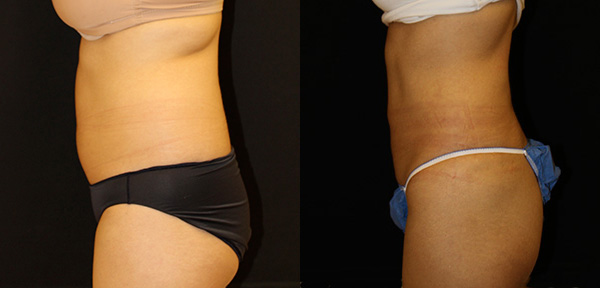 Liposuction before and after photos by Dr. Philip C. Kierney in Puyallup, WA