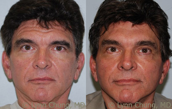 Neck Lift before and after photos by Dr. Philip C. Kierney in Puyallup, WA