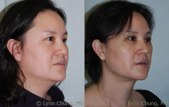 Full Facelift before and after photos by Dr. Philip C. Kierney in Puyallup, WA