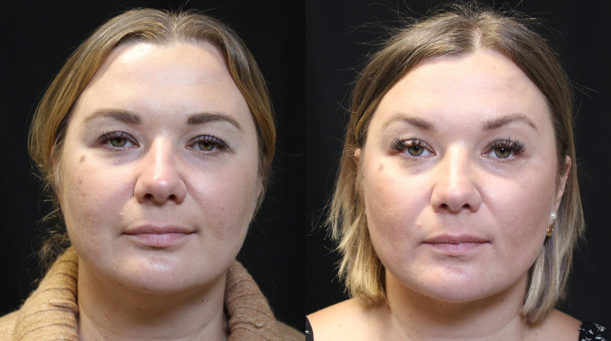 Brow Lift before and after photos by Dr. Philip C. Kierney in Puyallup, WA