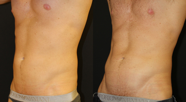 Liposuction before and after photos by Dr. Philip C. Kierney in Puyallup, WA