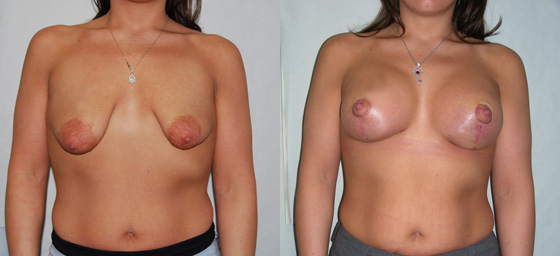 Mastopexy (Breast Lift) before and after photos by Dr. Philip C. Kierney in Puyallup, WA