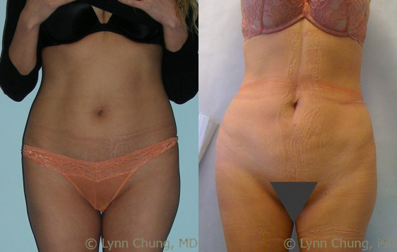Liposuction before and after photos by Dr. Philip C. Kierney in Puyallup, WA