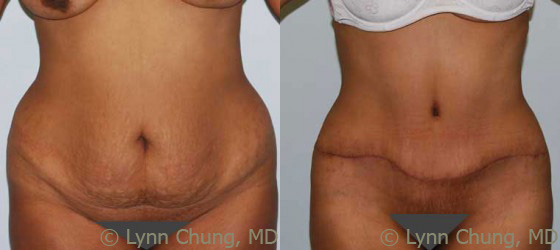 Abdominoplasty (Tummy Tuck) before and after photos by Dr. Philip C. Kierney in Puyallup, WA