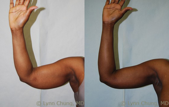 Liposuction before and after photos by Dr. Philip C. Kierney in Puyallup, WA
