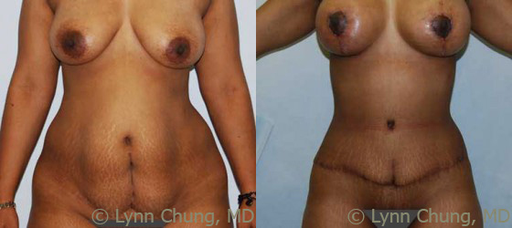 Abdominoplasty (Tummy Tuck) before and after photos by Dr. Philip C. Kierney in Puyallup, WA