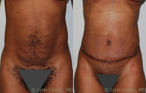 Abdominoplasty (Tummy Tuck) before and after photos by Dr. Philip C. Kierney in Puyallup, WA