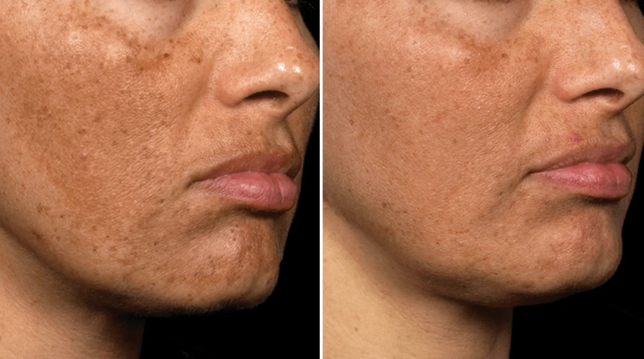 fraxel laser before after