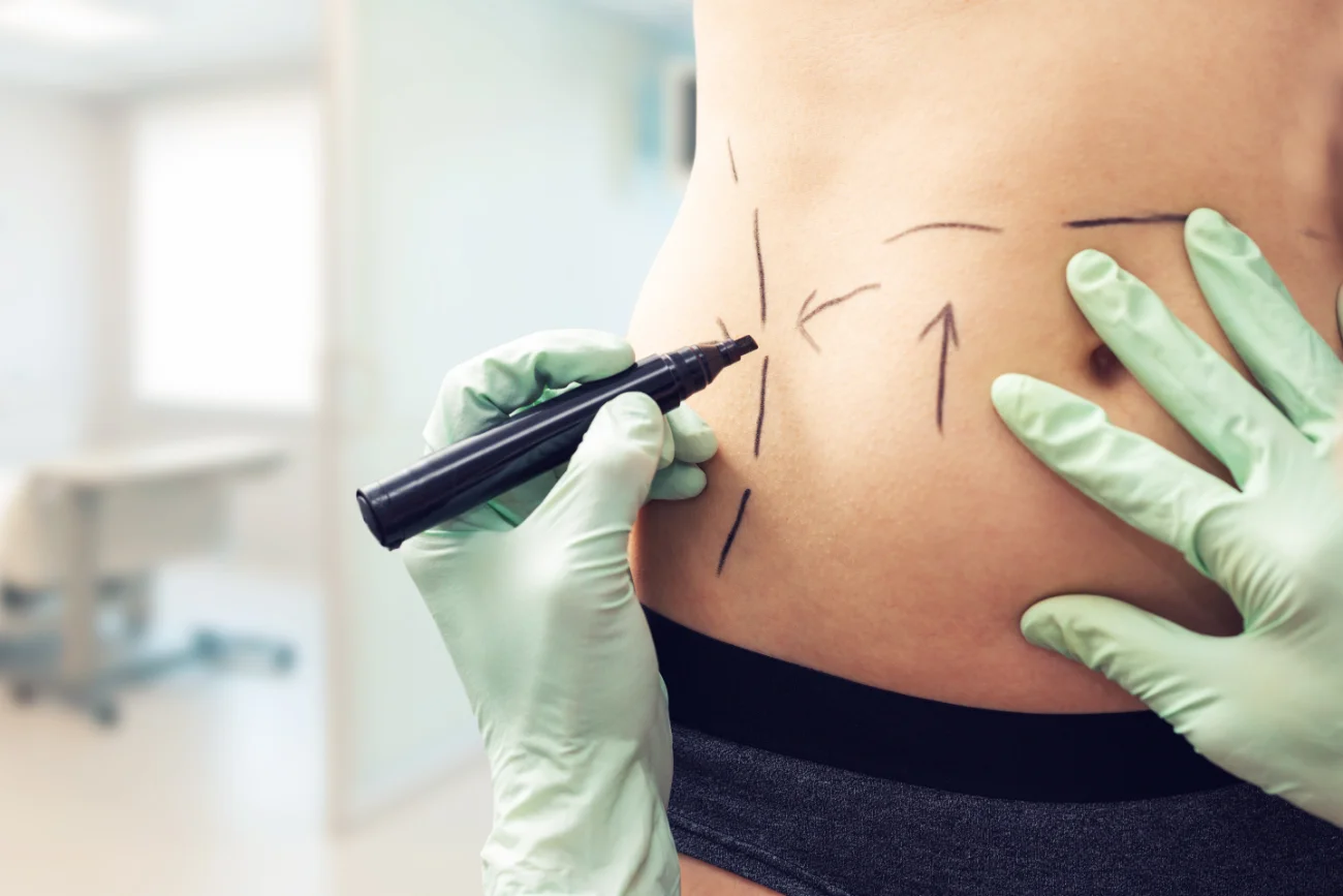 plastic surgeon marking womans body for liposuction