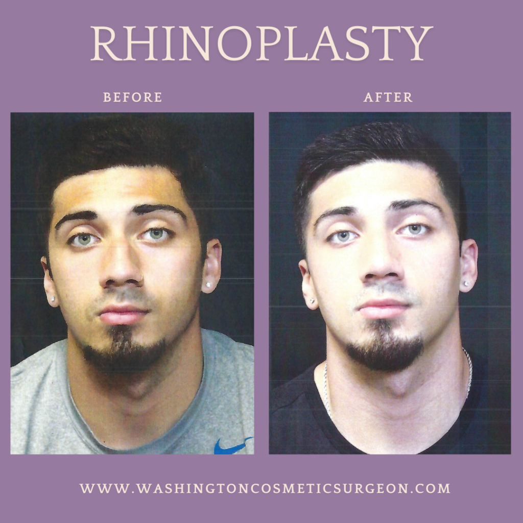 Rhinoplasty before and after photos by Dr. Philip C. Kierney in Puyallup, WA a