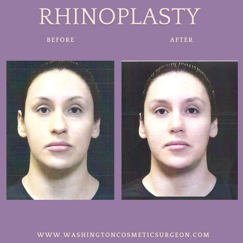 Rhinoplasty before and after photos by Dr. Philip C. Kierney in Puyallup, WA a