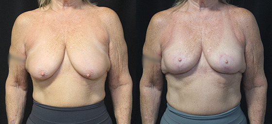 Breast Lift before and after photos by Dr. Philip C. Kierney in Puyallup, WA