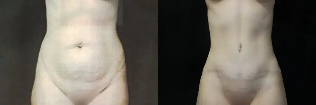 Front View Abdominoplasty before and after photos by Kierney and Chung Plastic Surgery