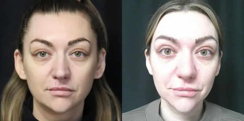 Front View Upper Blepharoplasty before and after photos by Kierney and Chung Plastic Surgery